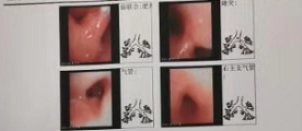 光明区首例新生儿纤维支气管镜检查 在中国科学院大学深圳医院成功完成