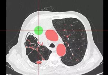 全球首例LungPro导航引导行BTPNA激光消融术